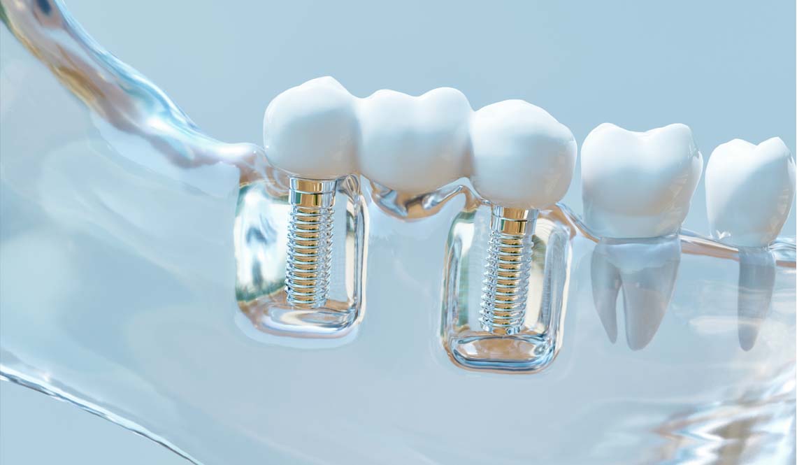 Dental Implants 